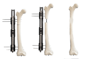AFA Limb Lengthening — clinic photo — photo 6