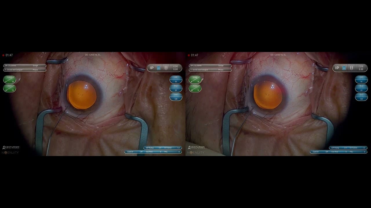 3D Surgery: Basics of Phacoemulsification: Incisions (Part 1/6) - YouTube