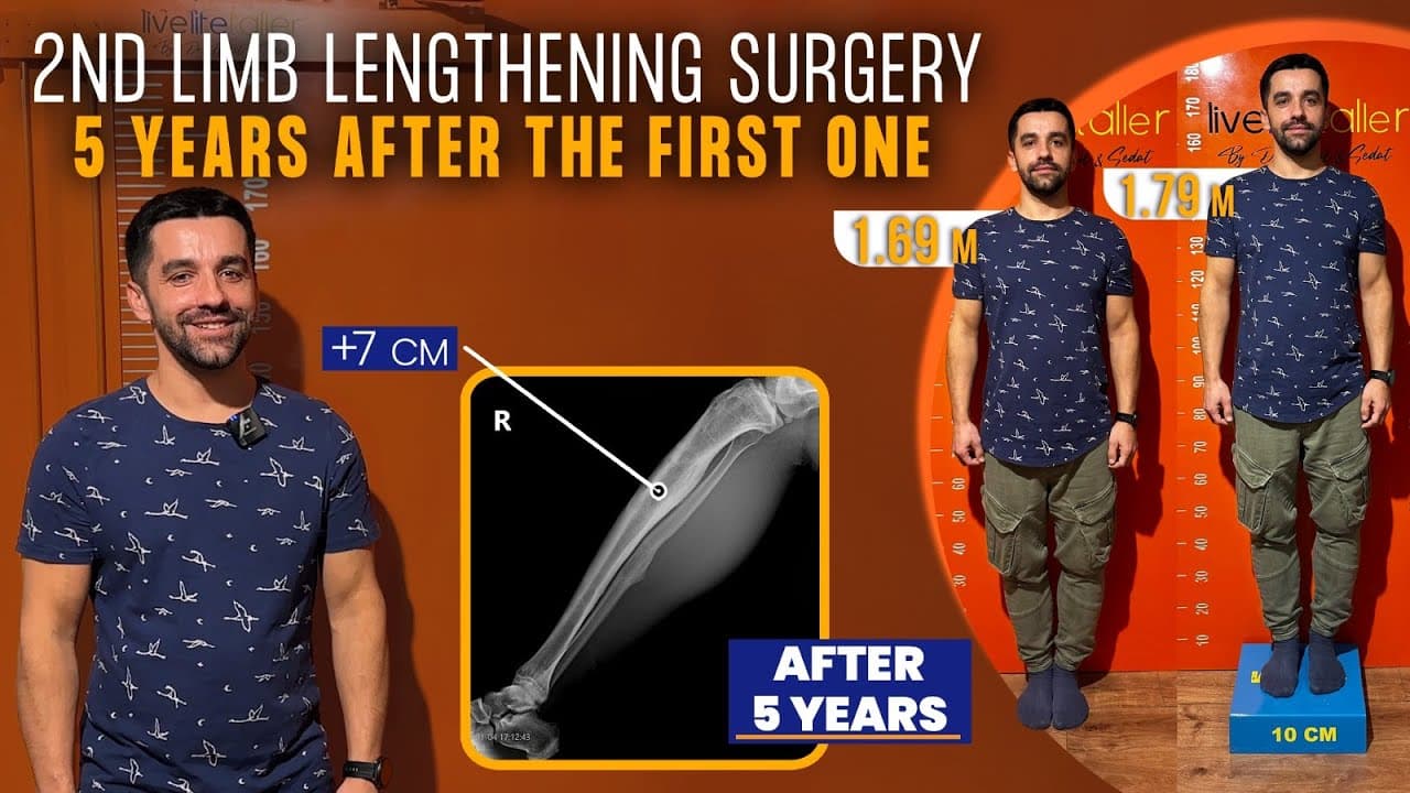 FIVE YEARS AFTER THE FIRST LIMB LENGTHENING ...
